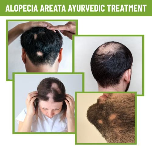alopecia areata medicine